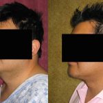 Male Neck & Face Liposuction Before & After Patient #12490