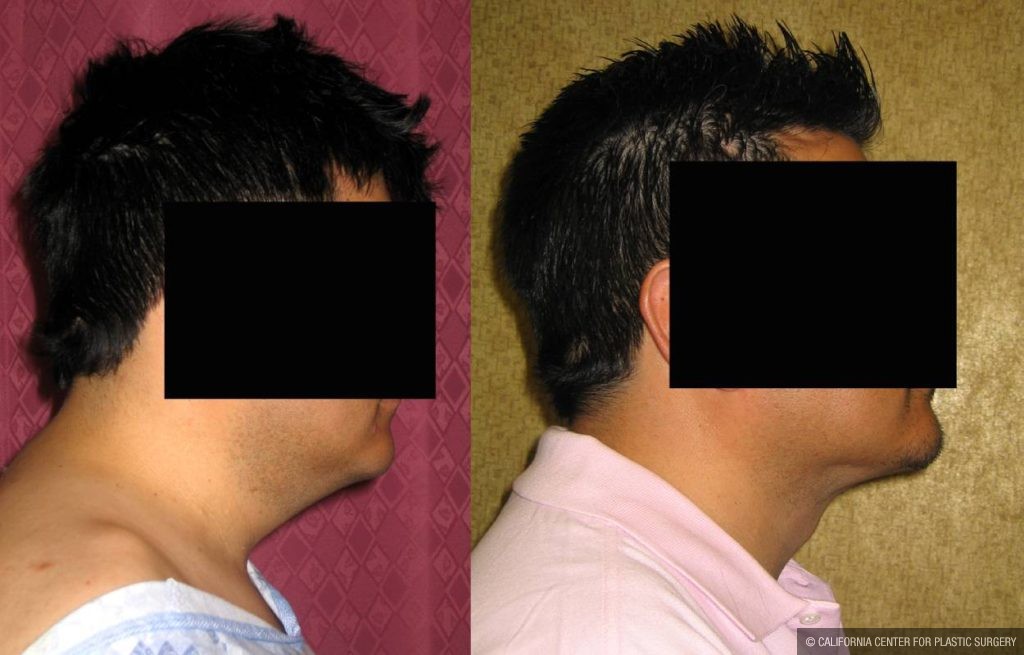 Male Neck & Face Liposuction Before & After Patient #12490