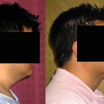 Male Neck & Face Liposuction Before & After Patient #12490