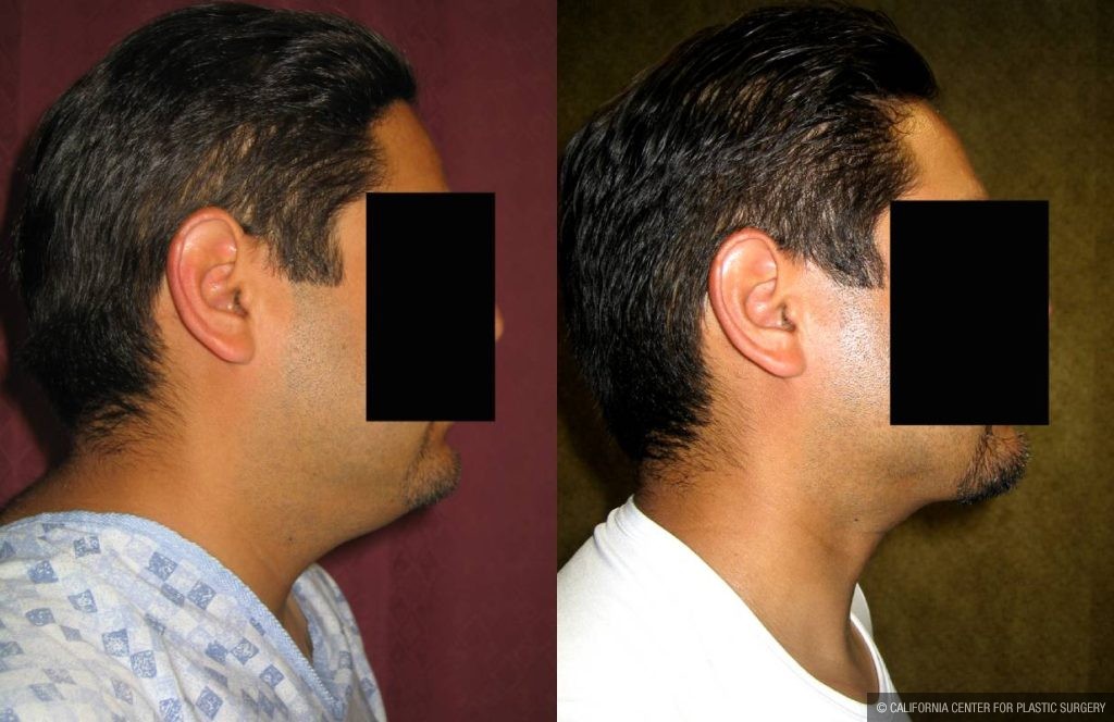 Male Neck & Face Liposuction Before & After Patient #12491