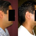 Male Neck & Face Liposuction Before & After Patient #12491