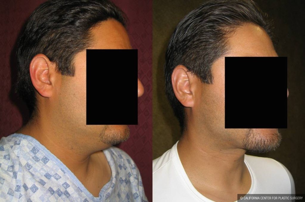 Male Neck & Face Liposuction Before & After Patient #12491
