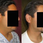 Male Neck & Face Liposuction Before & After Patient #12491