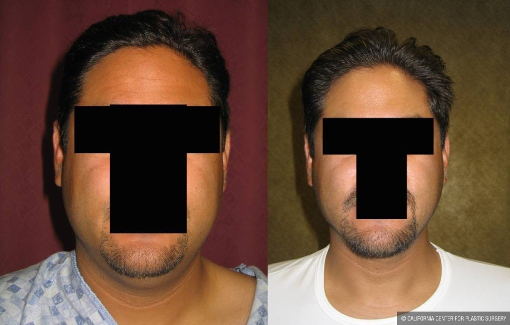 Male Neck & Face Liposuction Before & After Patient #12491