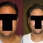 Male Neck & Face Liposuction Before & After Patient #12491