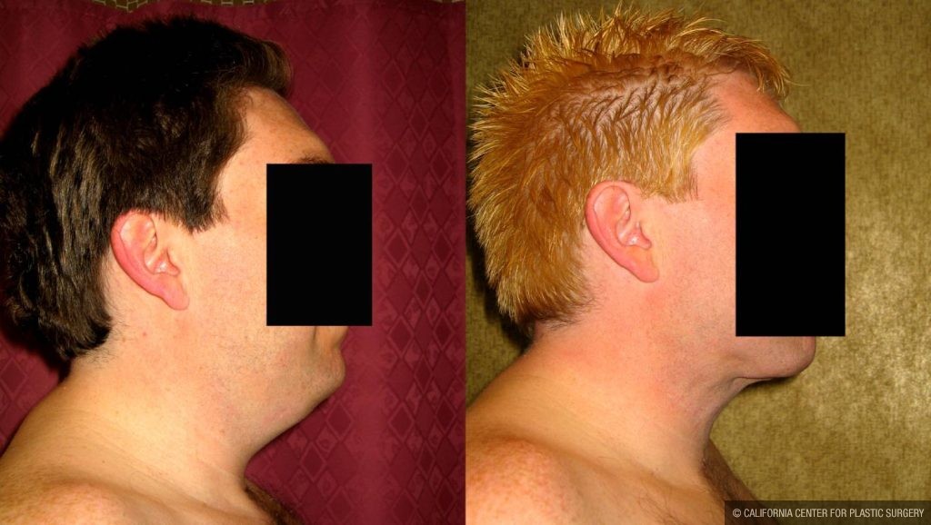 Male Neck & Face Liposuction Before & After Patient #12492