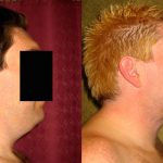 Male Neck & Face Liposuction Before & After Patient #12492