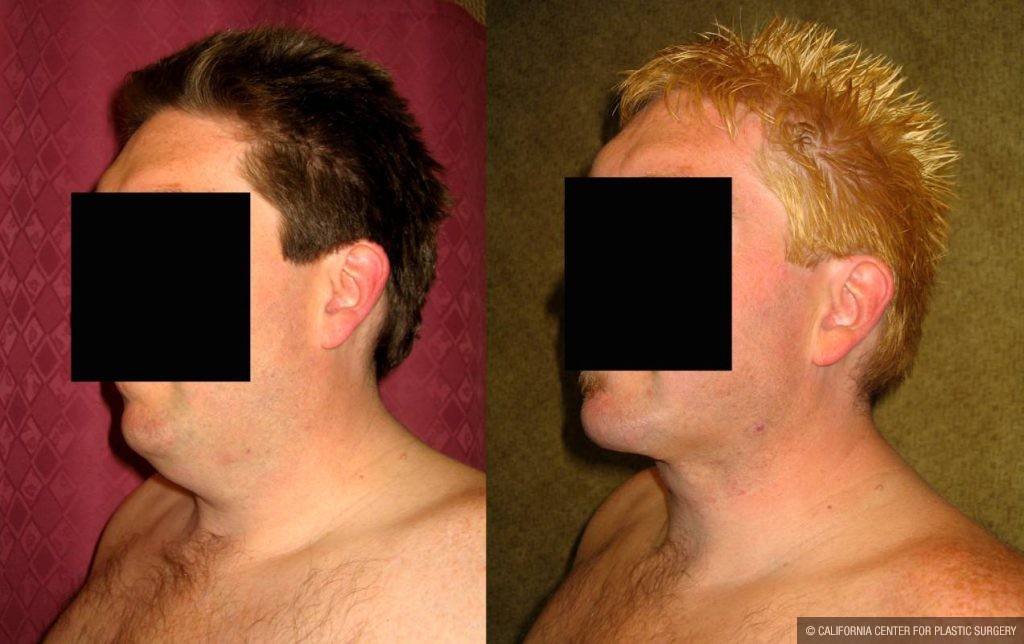 Male Neck & Face Liposuction Before & After Patient #12492