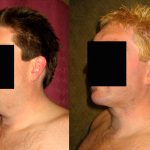 Male Neck & Face Liposuction Before & After Patient #12492