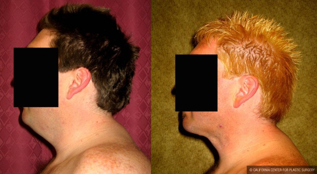 Male Neck & Face Liposuction Before & After Patient #12492