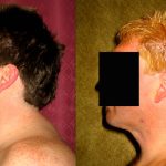 Male Neck & Face Liposuction Before & After Patient #12492