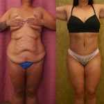 Body Lift Before & After Patient #12514