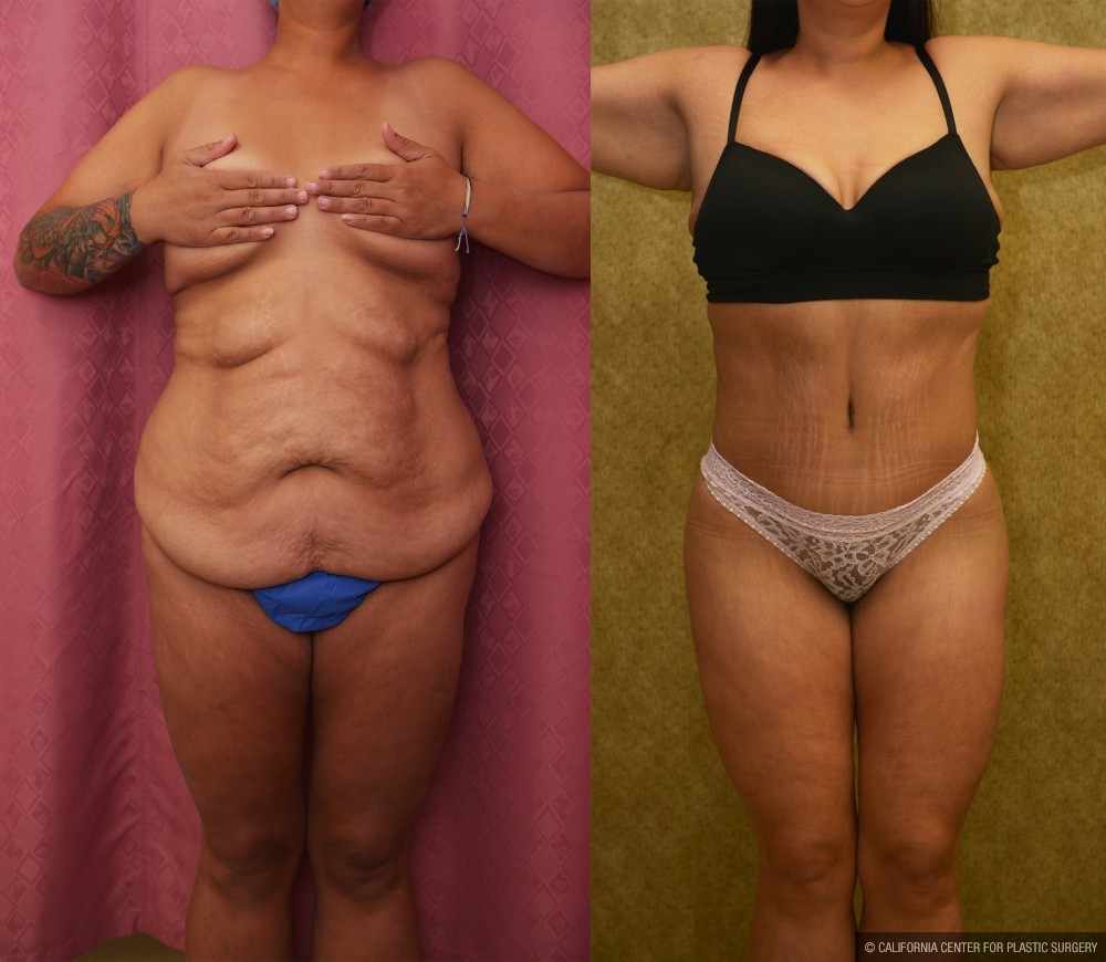 Body Lift Before & After Patient #12514