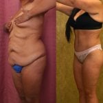 Body Lift Before & After Patient #12514