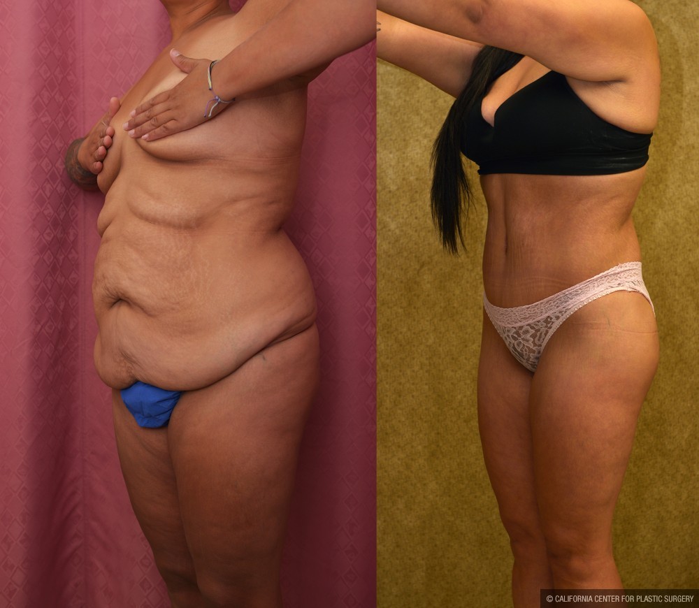 Body Lift Before & After Patient #12514