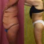 Body Lift Before & After Patient #12514