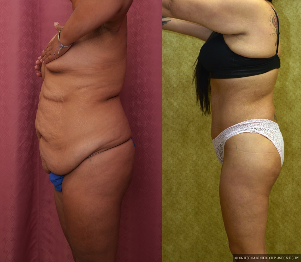 Body Lift Before & After Patient #12514