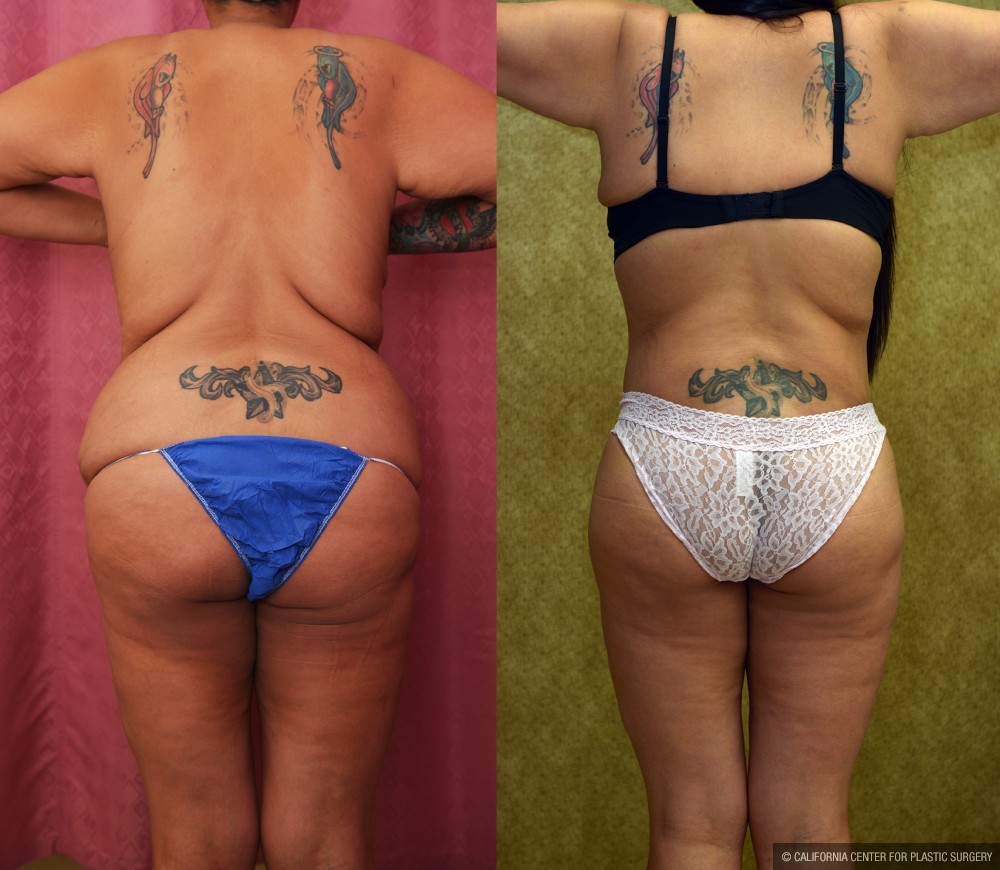 Body Lift Before & After Patient #12514