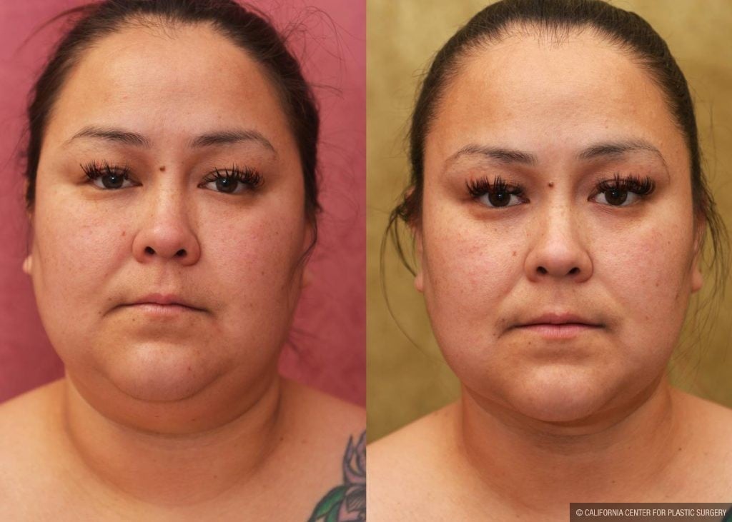 Neck & Face Liposuction Before & After Patient #12507