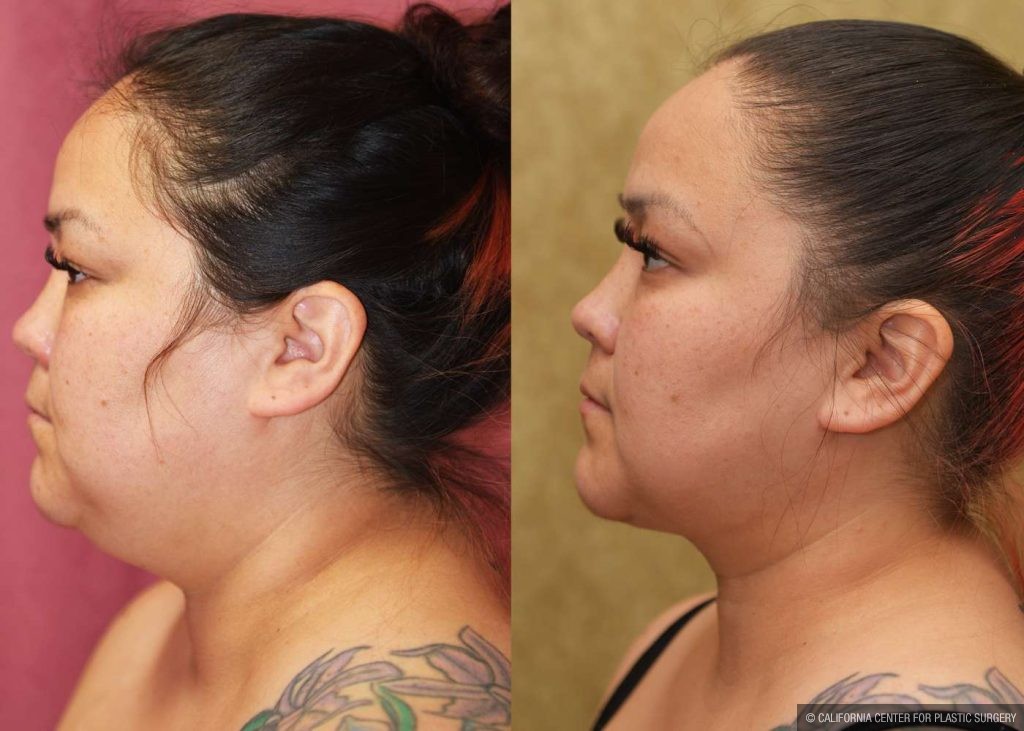 Neck & Face Liposuction Before & After Patient #12507