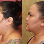 Neck & Face Liposuction Before & After Patient #12507