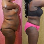 African American Tummy Tuck (Abdominoplasty) Before & After Patient #12577