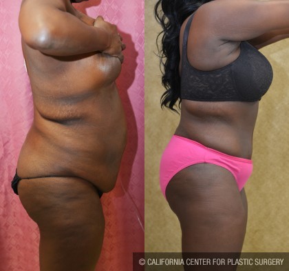 African American Tummy Tuck (Abdominoplasty) Before & After Patient #12577