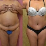 African American Tummy Tuck (Abdominoplasty) Before & After Patient #12572