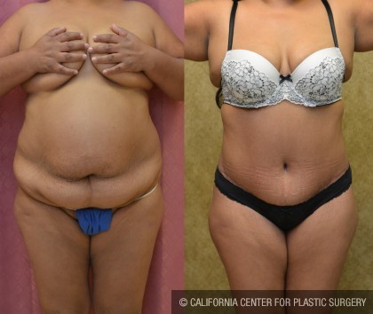 African American Tummy Tuck (Abdominoplasty) Before & After Patient #12572