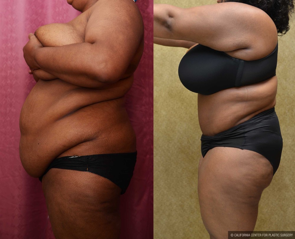 African American Tummy Tuck (Abdominoplasty) Before & After Patient #12546