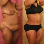 African American Tummy Tuck (Abdominoplasty) Before & After Patient #12585
