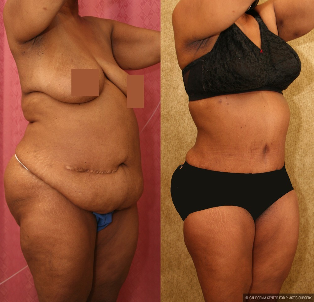 African American Tummy Tuck (Abdominoplasty) Before & After Patient #12585