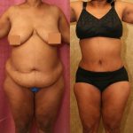 African American Tummy Tuck (Abdominoplasty) Before & After Patient #12585