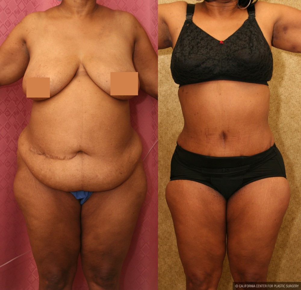 African American Tummy Tuck (Abdominoplasty) Before & After Patient #12585