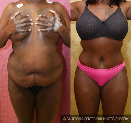 African American Tummy Tuck (Abdominoplasty) Before & After Patient #12577