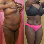 African American Tummy Tuck (Abdominoplasty) Before & After Patient #12577