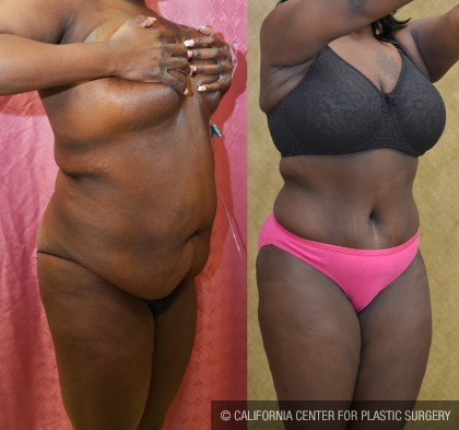 African American Tummy Tuck (Abdominoplasty) Before & After Patient #12577