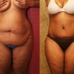 African American Tummy Tuck (Abdominoplasty) Before & After Patient #12567