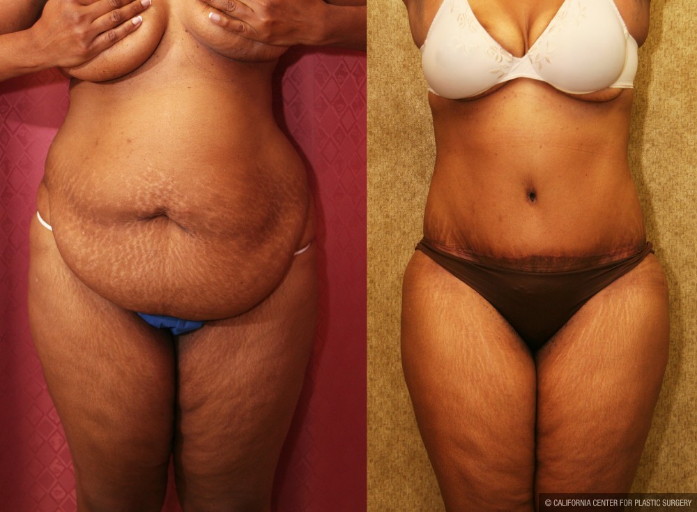 African American Tummy Tuck (Abdominoplasty) Before & After Patient #12567