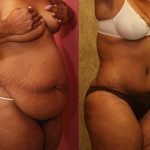 African American Tummy Tuck (Abdominoplasty) Before & After Patient #12567