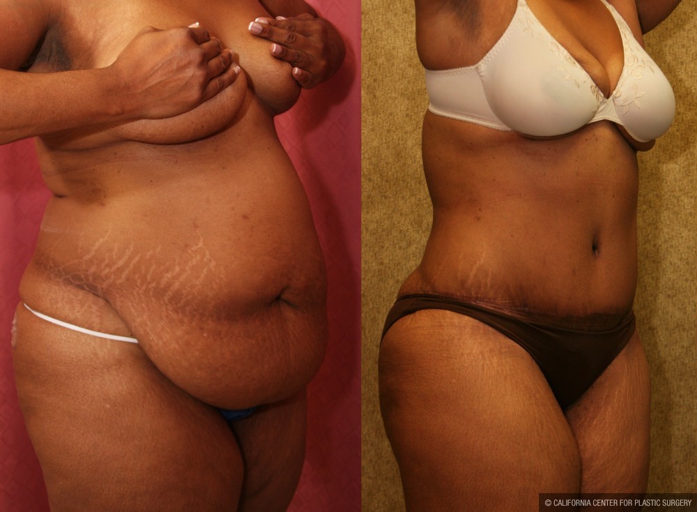 African American Tummy Tuck (Abdominoplasty) Before & After Patient #12567