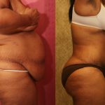 African American Tummy Tuck (Abdominoplasty) Before & After Patient #12567