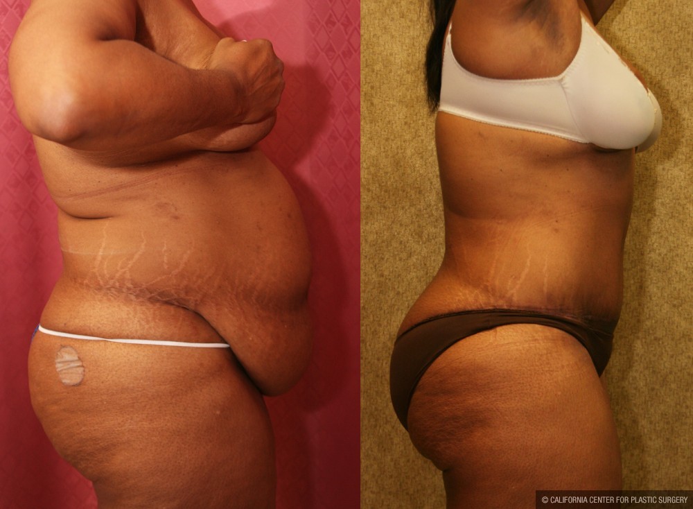 African American Tummy Tuck (Abdominoplasty) Before & After Patient #12567