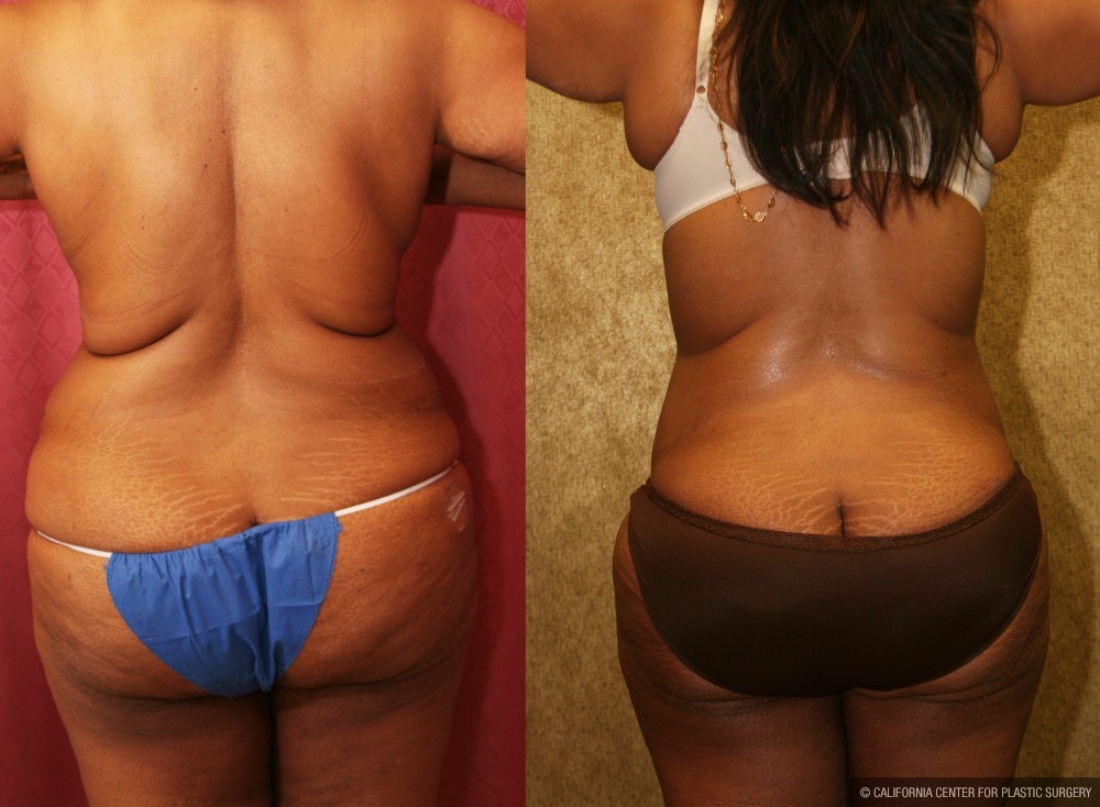 African American Tummy Tuck (Abdominoplasty) Before & After Patient #12567