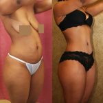 African American Tummy Tuck (Abdominoplasty) Before & After Patient #12542