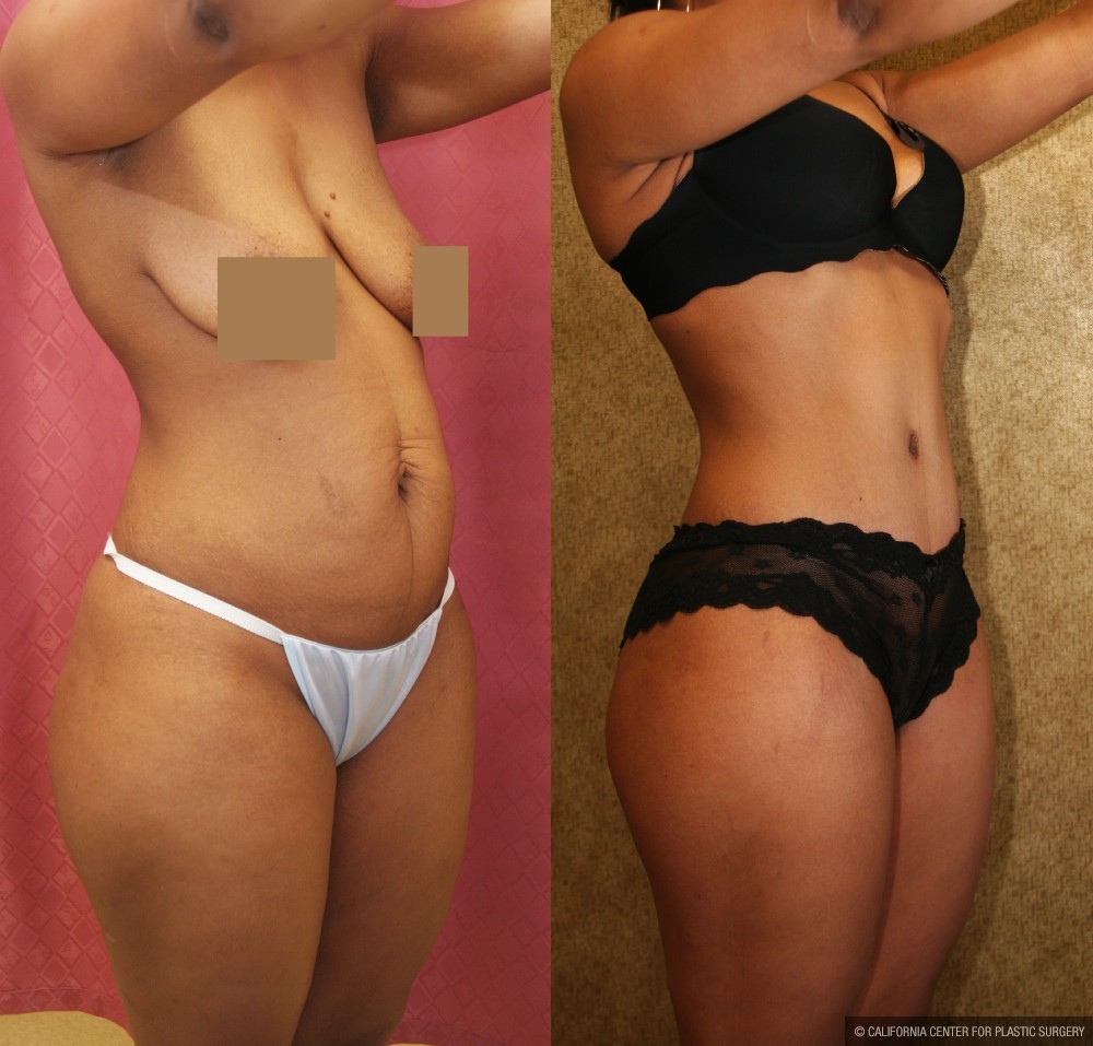 African American Tummy Tuck (Abdominoplasty) Before & After Patient #12542