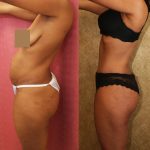 African American Tummy Tuck (Abdominoplasty) Before & After Patient #12542