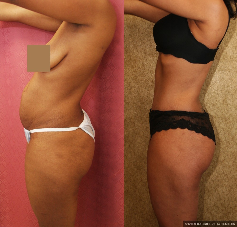 African American Tummy Tuck (Abdominoplasty) Before & After Patient #12542