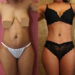 African American Tummy Tuck (Abdominoplasty) Before & After Patient #12542