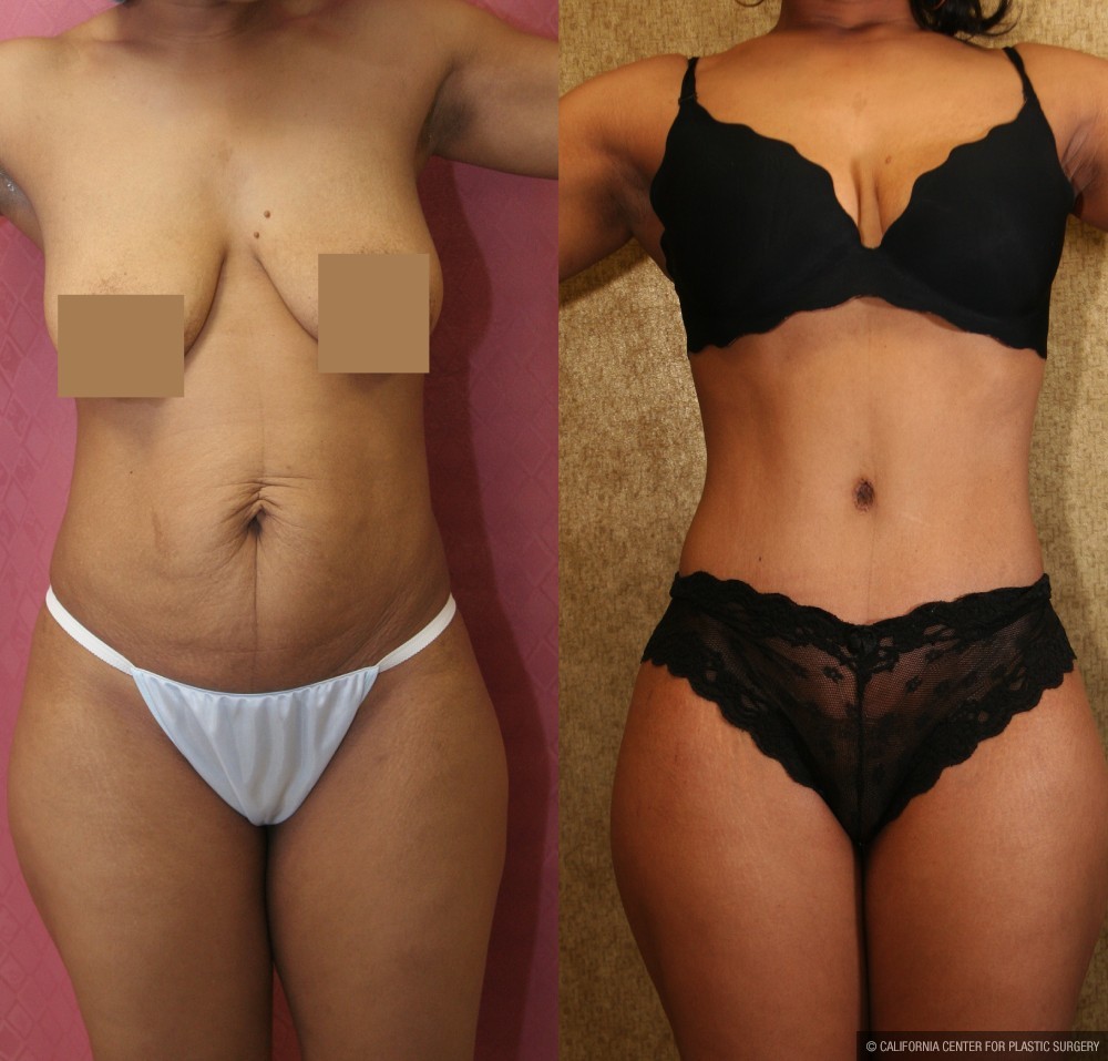 African American Tummy Tuck (Abdominoplasty) Before & After Patient #12542
